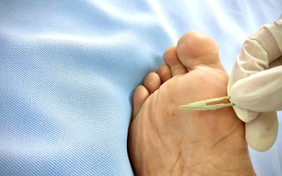 Find Effective Solutions for Chronic Soreness With Heel Pain Treatment in Bel Air, MD