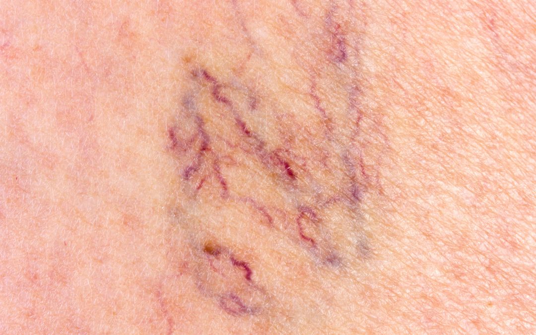 Your Guide to Effective Varicose Veins Treatment in Virginia Beach, VA for Lasting Relief