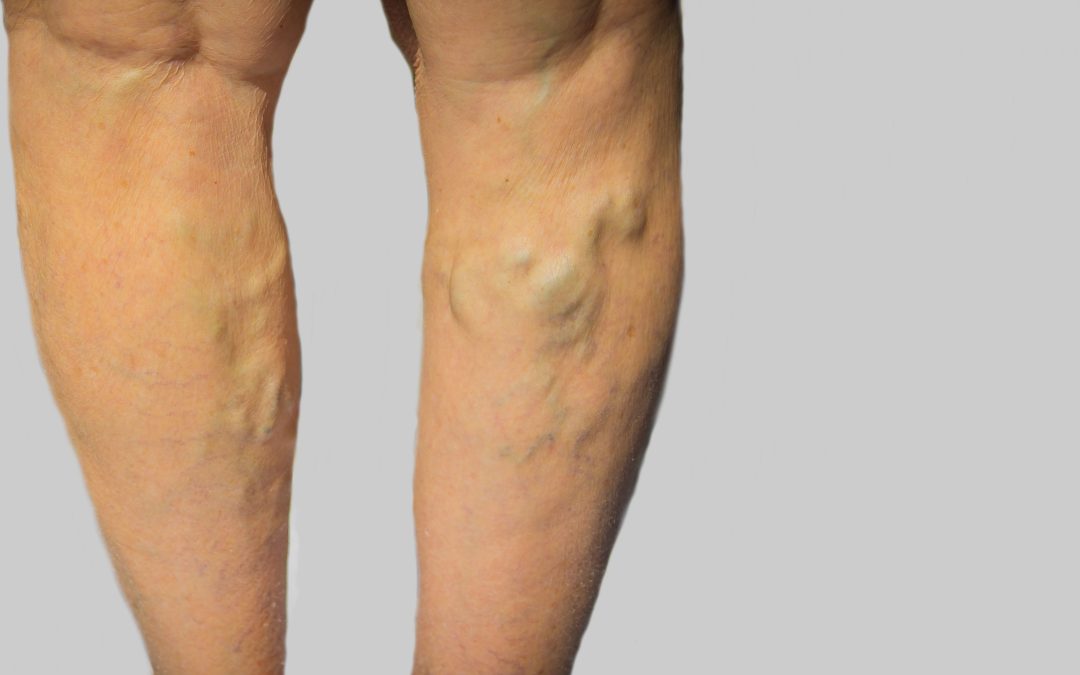 Local Treatment Options for Deep Vein Thrombosis in Warrenton, VA You Can Trust