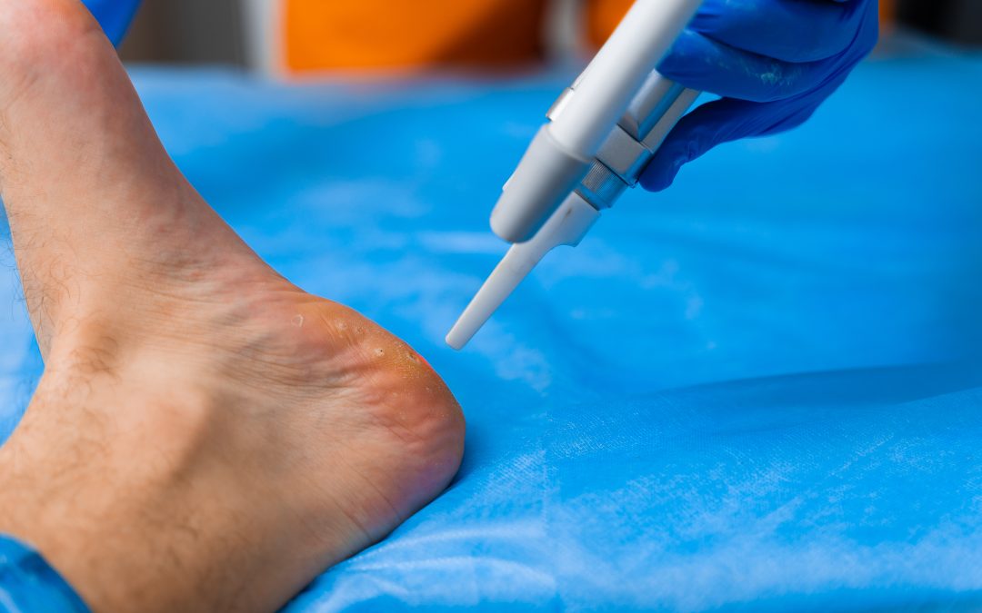 Walking Pain Free Is Possible with Advanced Bunion Treatment, Cypress, TX Solutions
