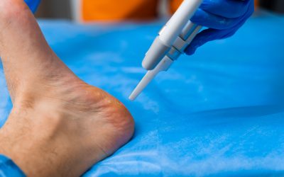 Walking Pain Free Is Possible with Advanced Bunion Treatment, Cypress, TX Solutions