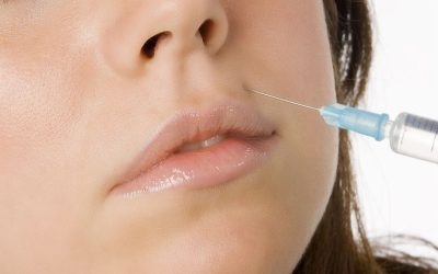 Achieve Fuller Lips Safely with Lip Fillers in Venice FL and Expert Guidance